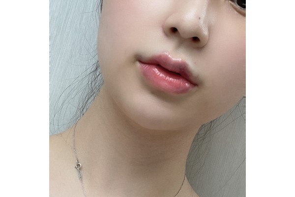 입술필러 했쪄용