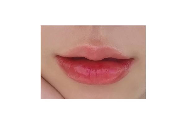 입술필러 받았어요