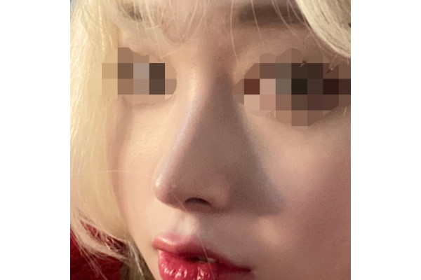 [수술 전/3개월 후 후기] 매부리코 무보형물 코성형 (귀연골+비중격)