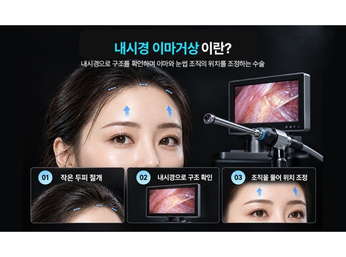 내시경 이마거상 수술 과정 알아보기, 절개부터 고정까지