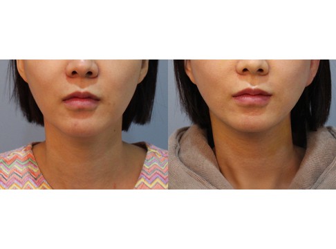 미니거상+이중턱지방흡입