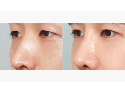 코 성형