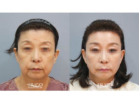 안면목거상+이마거상+상안검+피치거상+눈위지방재배치+지방흡입