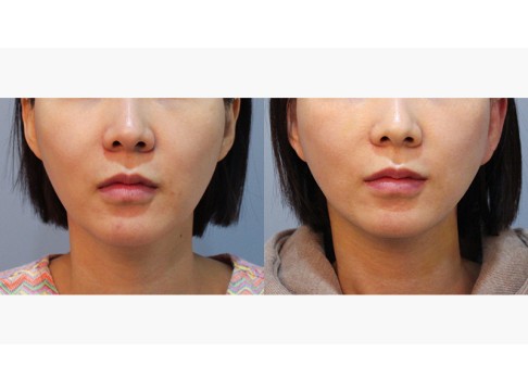 미니거상 + 이중턱 지방흡입