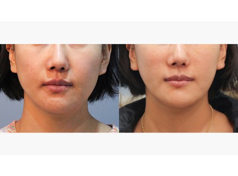 비절개 애플업 리프팅