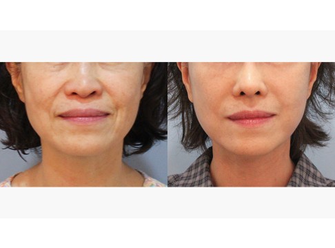 안면목거상+하안검+코