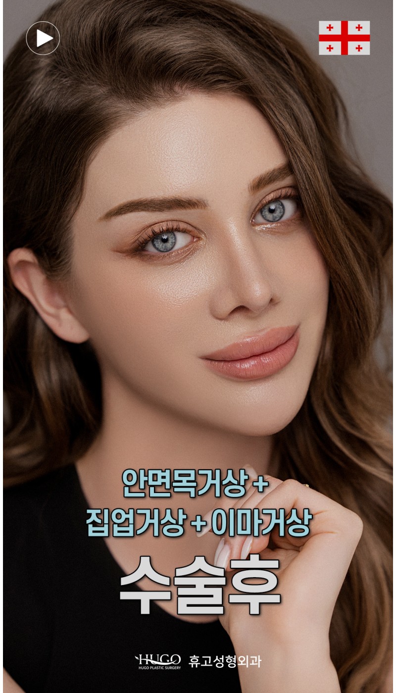 안면목거상,이마거상,집업거상 3가지를 동시에!?✈️조지아 여성이 한국성형 받으면 생기는 일
