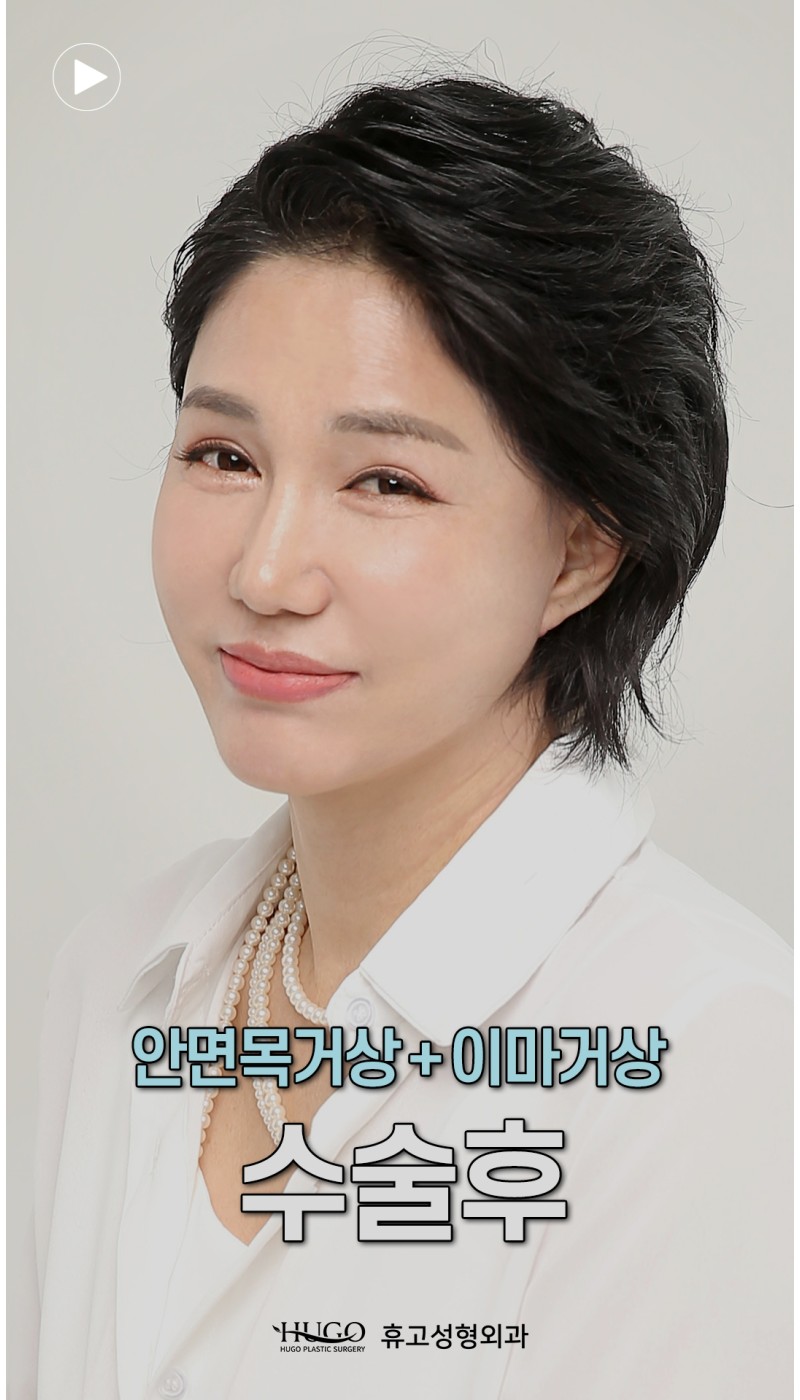 이마거상+안면거상 수술로 되찾은 리즈시절 | 60대 여성의 놀라운 전후 변화✨