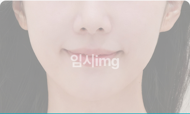 목거상술 후 선명한 턱선과 목선