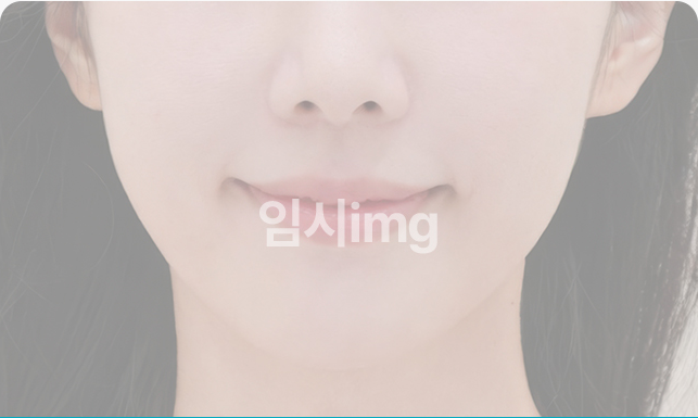 목거상술 후 매끈한 측면 목선